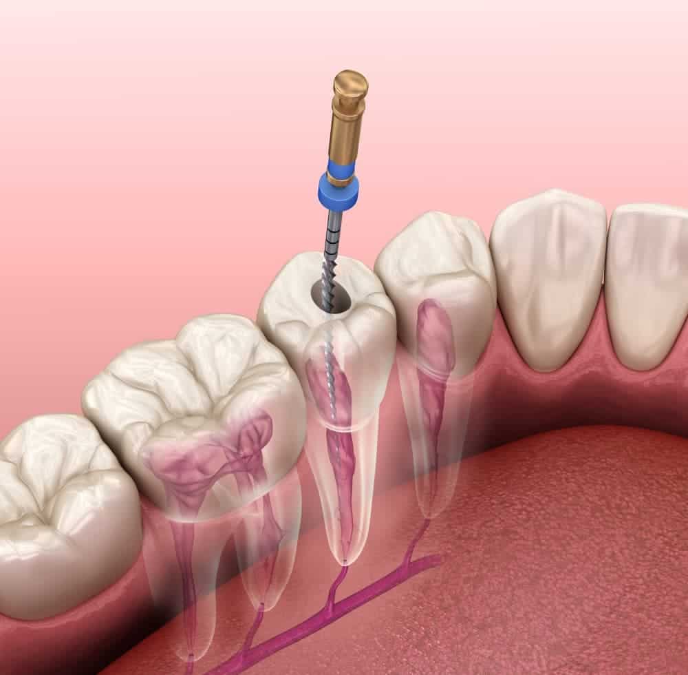 4 lí do nên bọc răng sứ sau khi điều trị tủy răng?