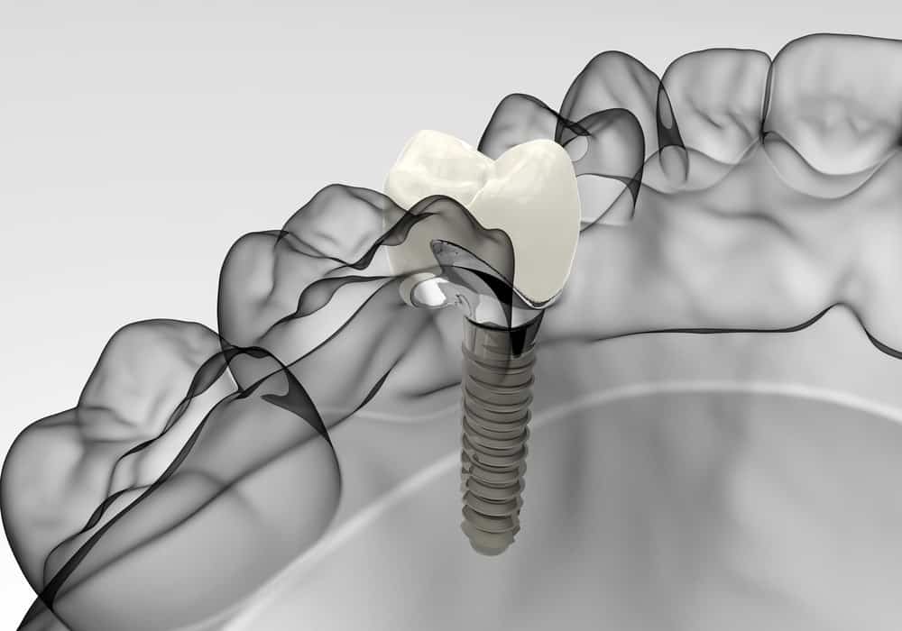Cấy ghép Implant an toàn nhất nhưng bạn có phải đối tượng phù hợp không?