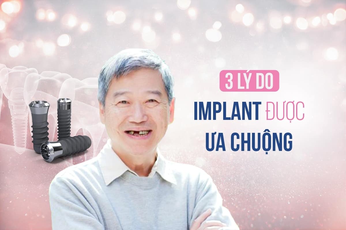 3 lý do Implant tại id lại được khách hàng ưa chuộng?