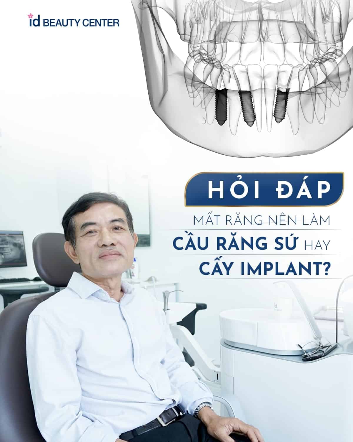 Hỏi đáp bác sĩ: Mất răng nên làm cầu răng sứ hay cắm Implant?